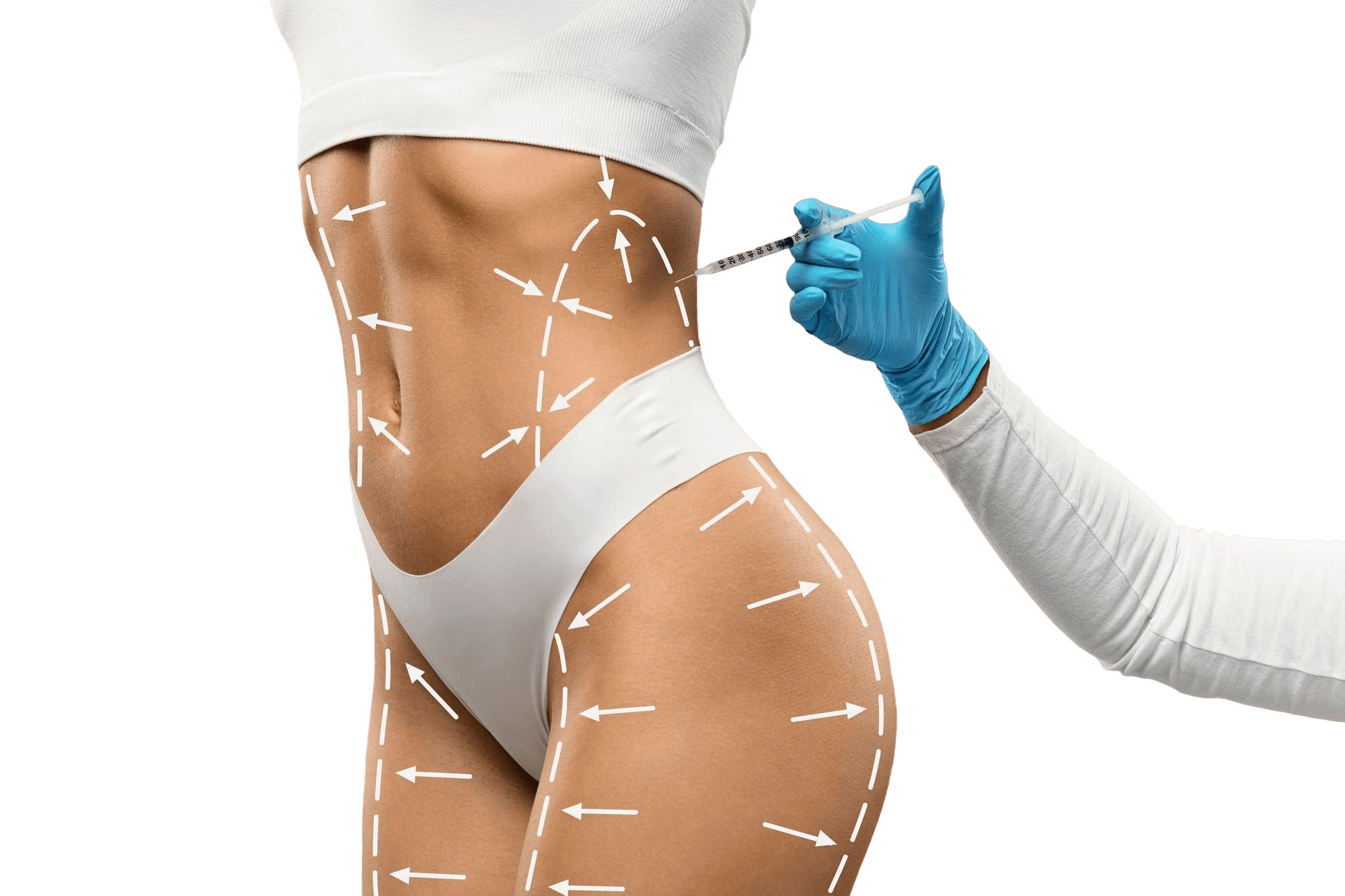 Липофилинг