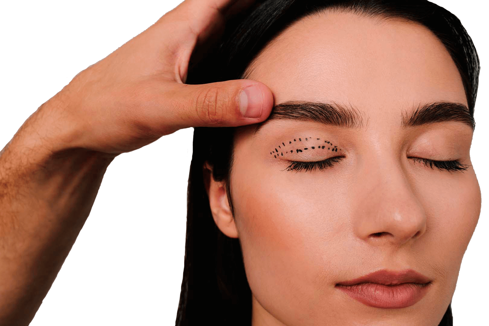 Блефаропластика