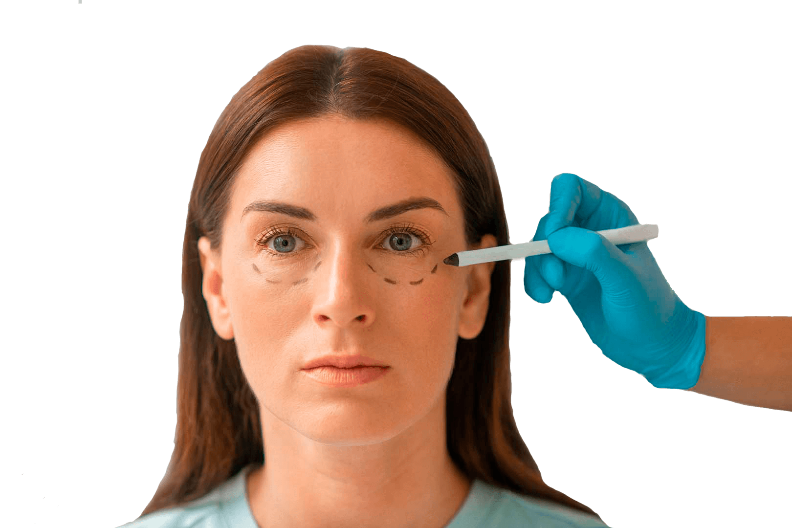 Нижняя Блефаропластика