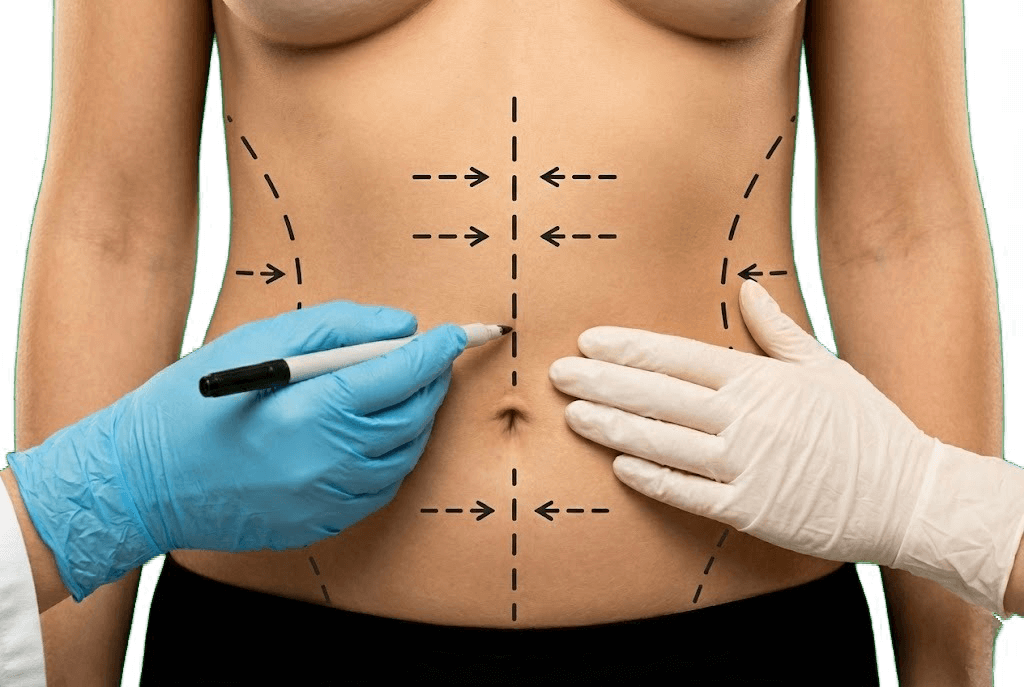 Ушивание диастаза