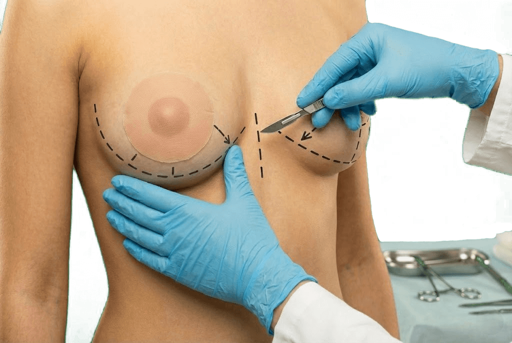 Уменьшение груди