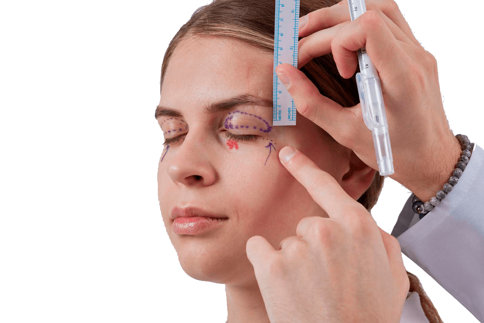 Верхняя Блефаропластика